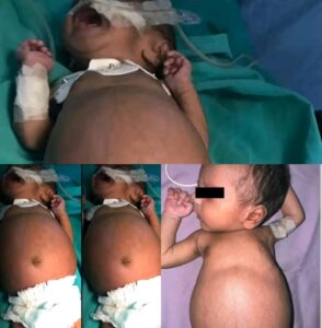 Newborn Girl Found “Pregnant” With Her Own Twin in Rare Medical Case