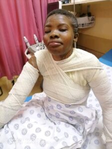 Tragic Acid Attack Leaves Limpopo Woman Scarred for Life in Love Triangle Drama