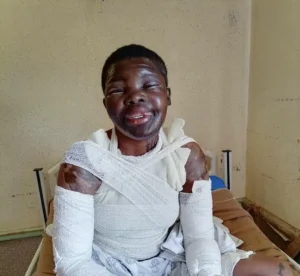 “She Scarred Me for Life”: Limpopo Woman Breaks Silence After Acid Attack by Jealous Ex’s Lover